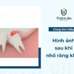 Cận cảnh hình ảnh sau khi nhổ răng khôn và quá trình phục hồi