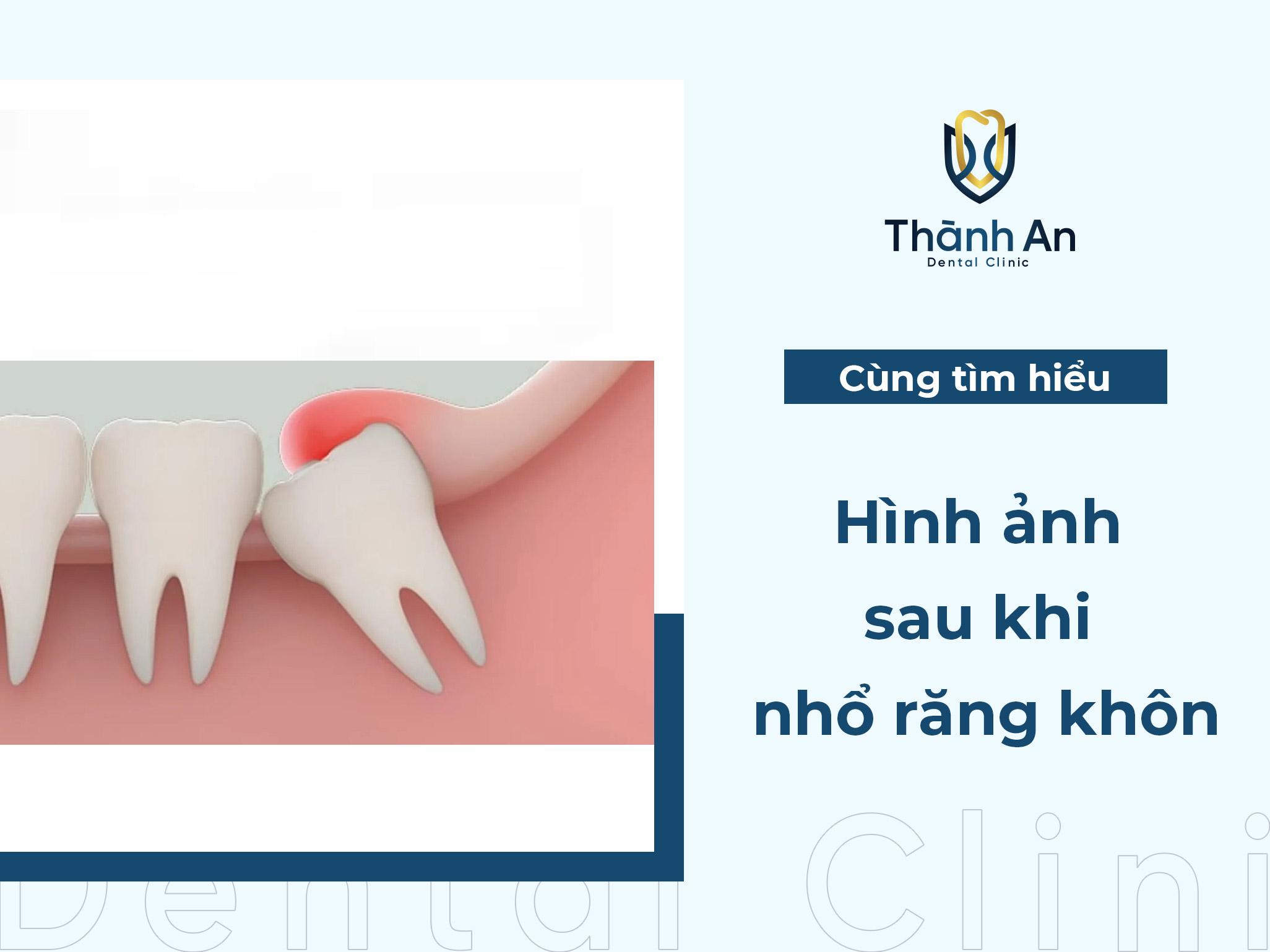 hình ảnh lợi sau khi nhổ răng