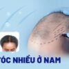 Rụng tóc nhiều ở nam giới: Nguyên nhân, dấu hiệu và ngăn ngừa