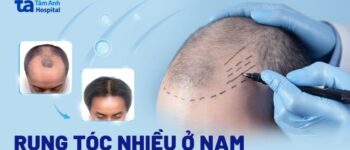 Rụng tóc nhiều ở nam giới: Nguyên nhân, dấu hiệu và ngăn ngừa