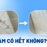 Xóa xăm có hết không? Điều gì ảnh hưởng đến kết quả triệt để?